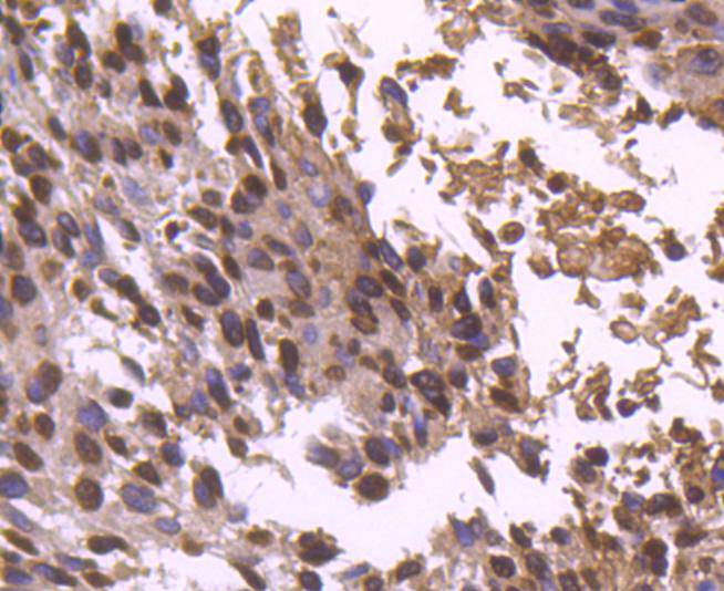 Fig8:; Immunohistochemical analysis of paraffin-embedded human breast carcinoma tissue using anti-Histone H2B antibody. The section was pre-treated using heat mediated antigen retrieval with Tris-EDTA buffer (pH 8.0-8.4) for 20 minutes.The tissues were blocked in 5% BSA for 30 minutes at room temperature, washed with ddH; 2; O and PBS, and then probed with the primary antibody ( 1/50) for 30 minutes at room temperature. The detection was performed using an HRP conjugated compact polymer system. DAB was used as the chromogen. Tissues were counterstained with hematoxylin and mounted with DPX.