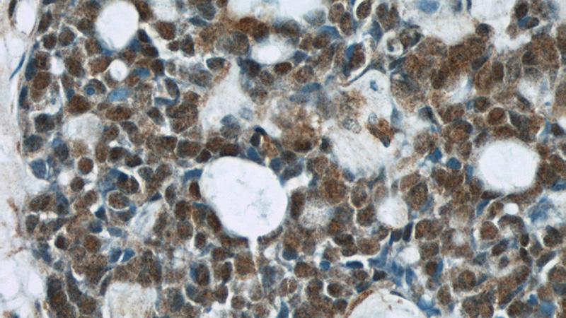Immunohistochemical of paraffin-embedded human cervical cancer using Catalog No:109271(CHOP; GADD153 antibody) at dilution of 1:50 (under 40x lens)
