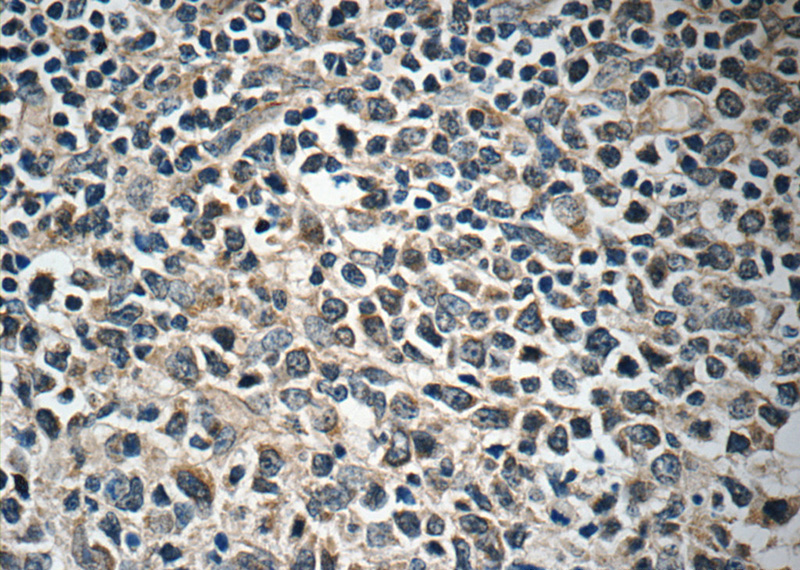 Immunohistochemistry of paraffin-embedded human lymphoma tissue slide using Catalog No:110545(FBXL18 Antibody) at dilution of 1:50 (under 40x lens)