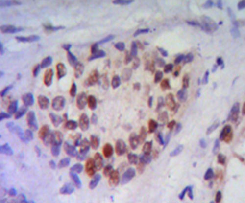 Fig3: Immunohistochemical analysis of paraffin-embedded human prostate tissue using anti-NKX3A antibody. Counter stained with hematoxylin.