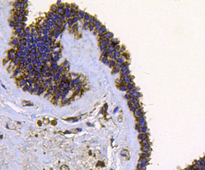 Fig4: Immunohistochemical analysis of paraffin-embedded human breast carcinoma tissue using anti-FGFR2 antibody. Counter stained with hematoxylin.