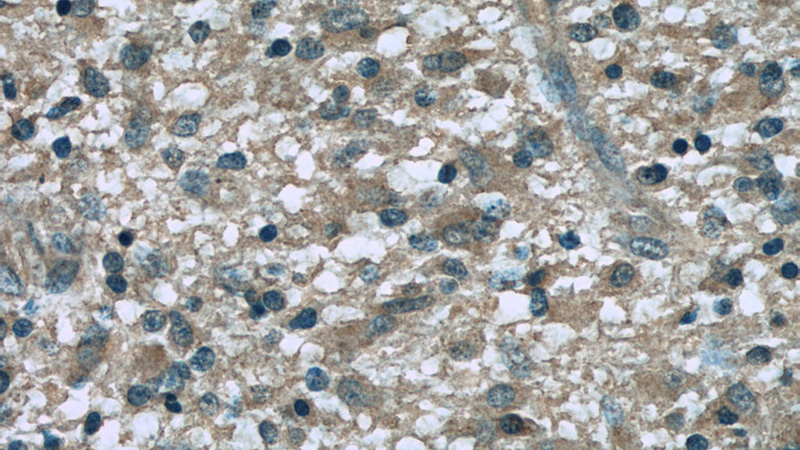 Immunohistochemistry of paraffin-embedded human gliomas slide using Catalog No:107243(dynactin-2 Antibody) at dilution of 1:50