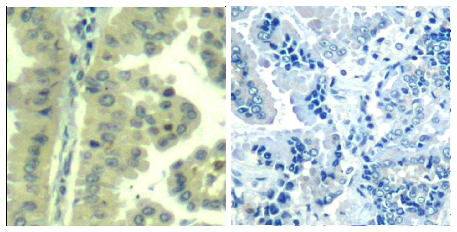 Immunohistochemical analysis of paraffin-embedded human lung carcinoma tissue using eIF4G (Ab-1232) Antibody  (left) or the same antibody preincubated with blocking peptide (right).