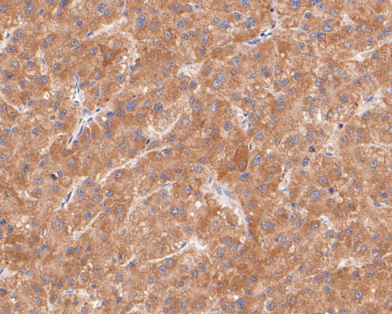 Fig3:; Immunohistochemical analysis of paraffin-embedded human liver tissue using anti-KCNK2 antibody. The section was pre-treated using heat mediated antigen retrieval with Tris-EDTA buffer (pH 8.0-8.4) for 20 minutes.The tissues were blocked in 5% BSA for 30 minutes at room temperature, washed with ddH; 2; O and PBS, and then probed with the primary antibody ( 1/100) for 30 minutes at room temperature. The detection was performed using an HRP conjugated compact polymer system. DAB was used as the chromogen. Tissues were counterstained with hematoxylin and mounted with DPX.