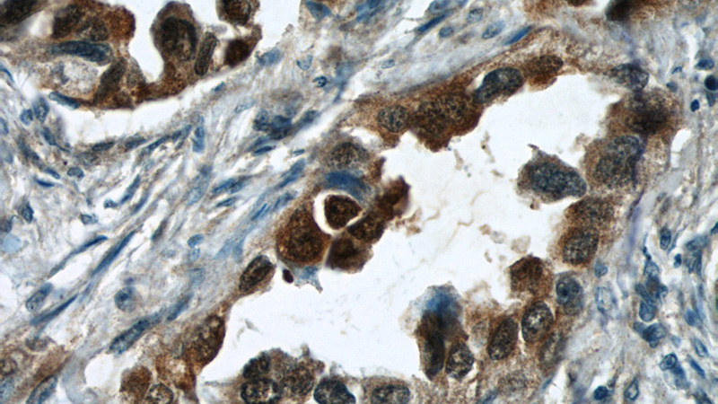 Immunohistochemical of paraffin-embedded human lung cancer using Catalog No:114967(S100P antibody) at dilution of 1:50 (under 40x lens)