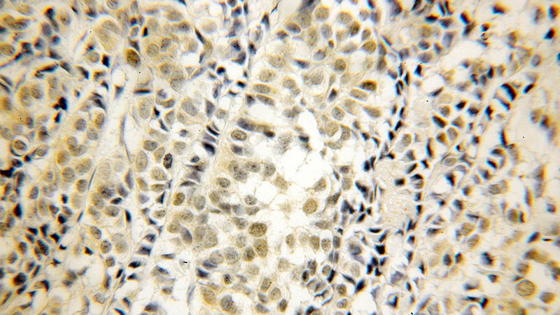 Immunohistochemical of paraffin-embedded human breast cancer using Catalog No:111466(HRPT2; CDC73 antibody) at dilution of 1:50 (under 10x lens)