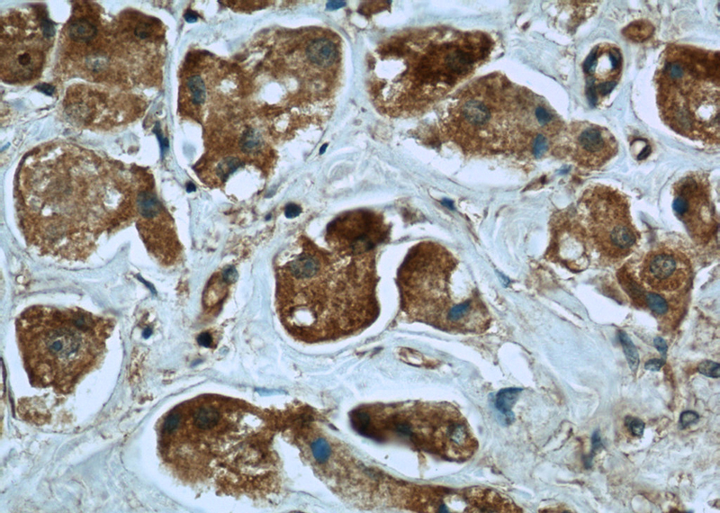 Immunohistochemistry of paraffin-embedded human breast cancer slide using Catalog No:113023(NBR1 Antibody) at dilution of 1:50