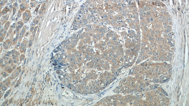 Immunohistochemical of paraffin-embedded human liver cancer using Catalog No:112388(MAGEC3 antibody) at dilution of 1:50 (under 10x lens)