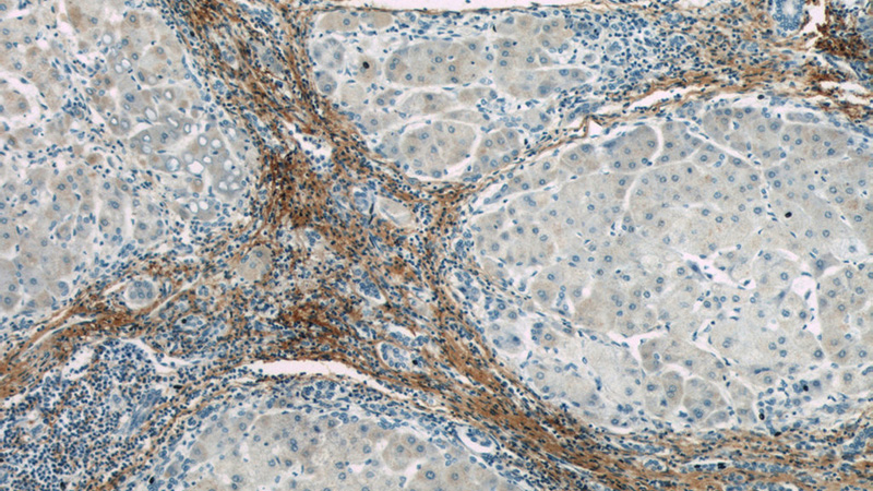 Immunohistochemistry of paraffin-embedded human hepatocirrhosis slide using Catalog No:107213(FMOD Antibody) at dilution of 1:50