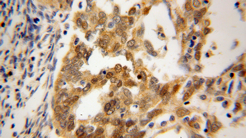 Immunohistochemical of paraffin-embedded human endometrial cancer using Catalog No:112598(MGEA5 antibody) at dilution of 1:100 (under 40x lens)