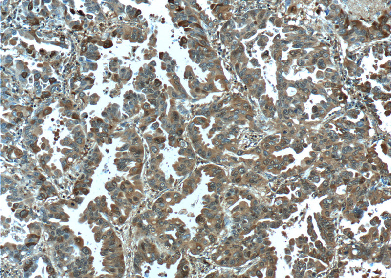 Immunohistochemistry of paraffin-embedded human lung cancer tissue slide using Catalog No:114461(RAB8B Antibody) at dilution of 1:50 (under 10x lens)