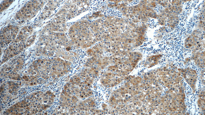 Immunohistochemistry of paraffin-embedded human liver cancer tissue slide using Catalog No:114117(PPP4R2 Antibody) at dilution of 1:50 (under 10x lens)