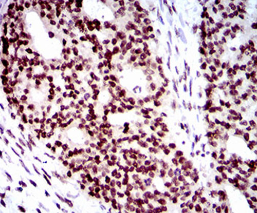 Fig6: Immunohistochemical analysis of paraffin-embedded human ovarian cancer tissue using anti-WHSC2 antibody. Counter stained with hematoxylin.