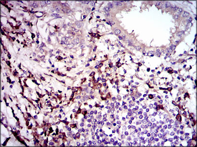 Immunohistochemical analysis of paraffin-embedded lung cancer tissues using TGFb1 mouse mAb with DAB staining.