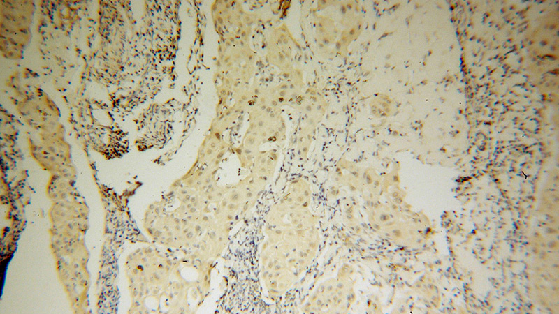 Immunohistochemical of paraffin-embedded human cervical cancer using Catalog No:117052(ZHX1 antibody) at dilution of 1:100 (under 10x lens)