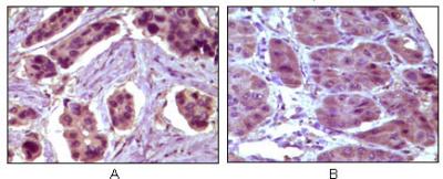Immunohistochemical analysis of paraffin-embedded human breast carcinoma (A) and liver carcinoma (B), showing cytoplasmic localization using BCL10 mouse mAb with DAB staining.