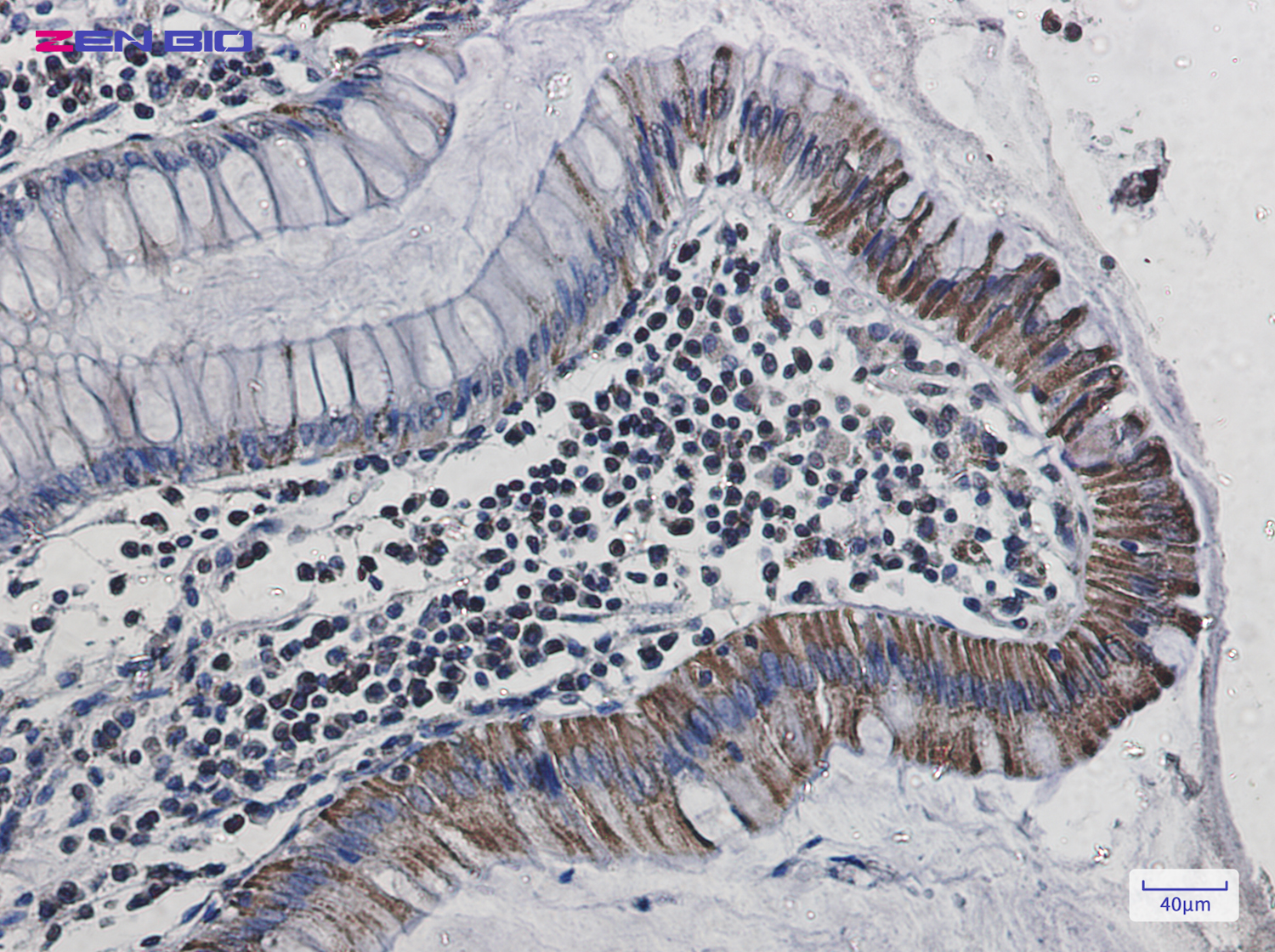 Immunohistochemistry of Cytochrome C Oxidase subunit Vic in paraffin-embedded Human colon cancer tissue using Cytochrome C Oxidase subunit Vic Rabbit pAb at dilution 1/20