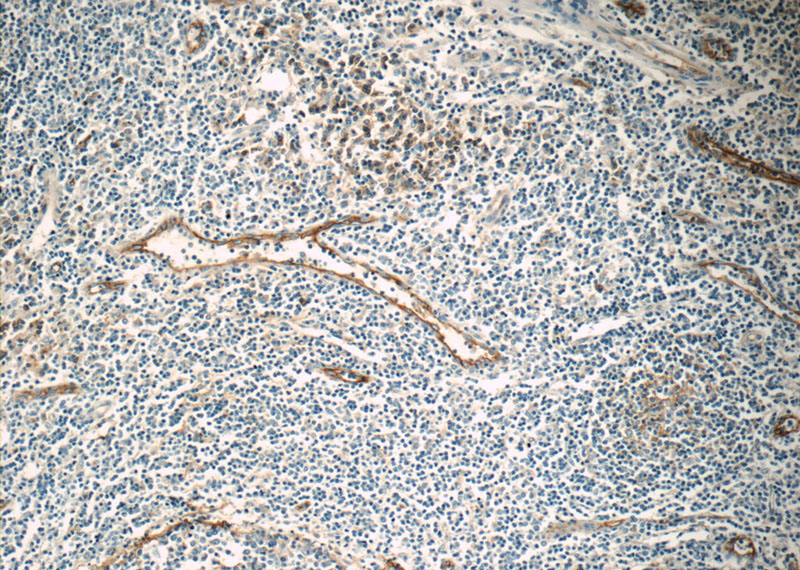 Immunohistochemistry of paraffin-embedded human tonsillitis tissue slide using Catalog No:107272(ICAM-1 Antibody) at dilution of 1:50 (under 10x lens)