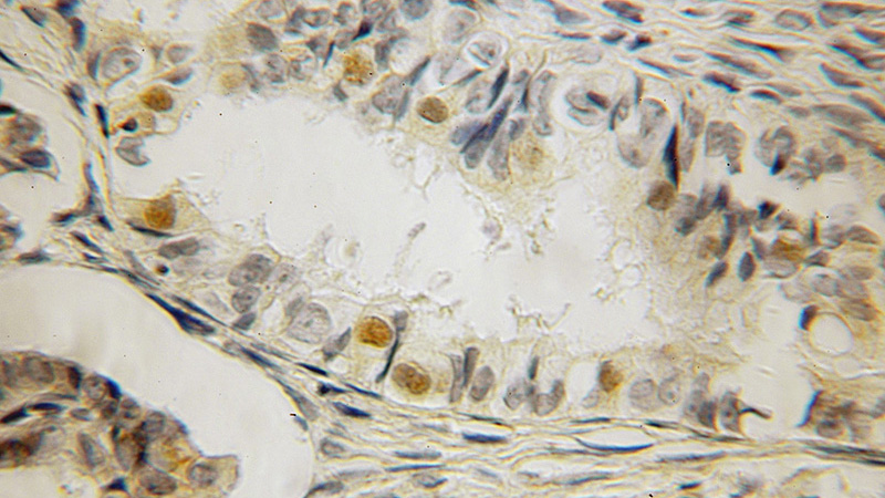 Immunohistochemical of paraffin-embedded human ovary tumor using Catalog No:112025(KDM3A,JMJD1A antibody) at dilution of 1:100 (under 10x lens)