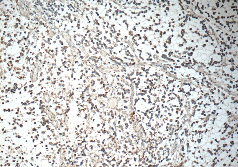 Immunohistochemistry of paraffin-embedded human gliomas tissue slide using Catalog No:111770(IL1F6 Antibody) at dilution of 1:50 (under 10x lens)