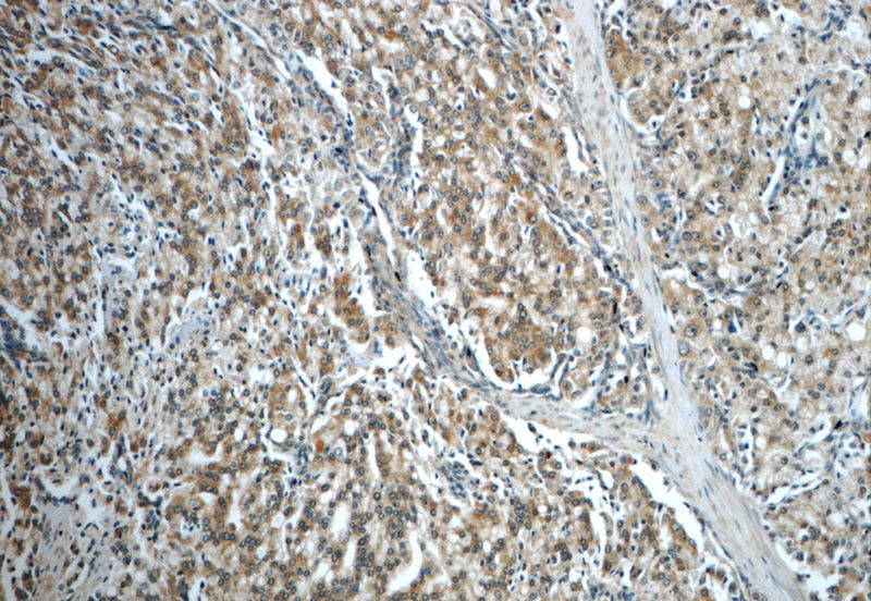 Immunohistochemistry of paraffin-embedded human prostate cancer slide using Catalog No:116607(USP33 Antibody) at dilution of 1:50(under 10x lens)