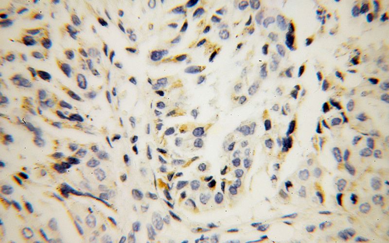 Immunohistochemical of paraffin-embedded human stomach cancer using Catalog No:112250(LMAN1 antibody) at dilution of 1:100 (under 40x lens)