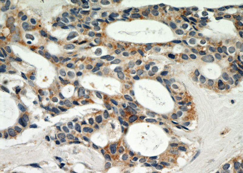 Immunohistochemical of paraffin-embedded human breast cancer using Catalog No:115290(SKP2 antibody) at dilution of 1:50 (under 40x lens)