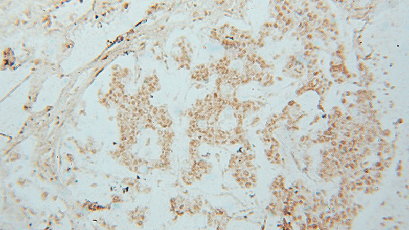 Immunohistochemical of paraffin-embedded human breast cancer using Catalog No:111408(HIST1H4E antibody) at dilution of 1:50 (under 10x lens)