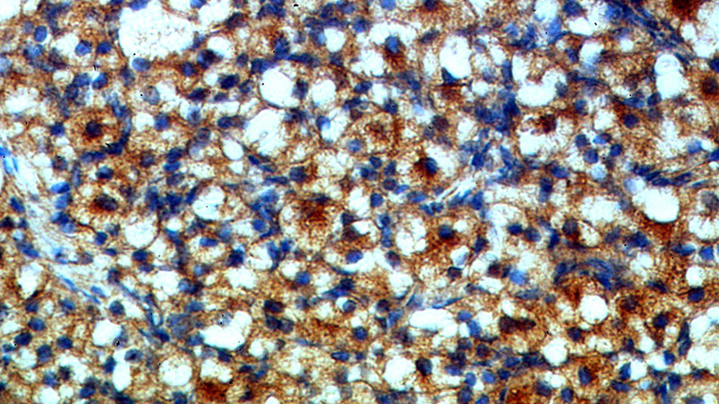 Immunohistochemical of paraffin-embedded human ovary using Catalog No:114067(POTEA-Specific antibody) at dilution of 1:50 (under 40x lens)