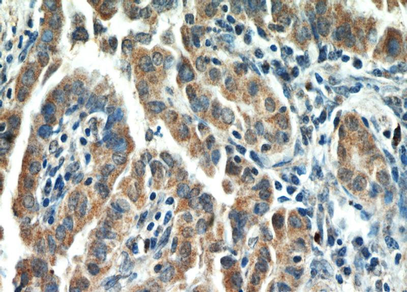 Immunohistochemical of paraffin-embedded human thyroid cancer using Catalog No:111345(HIF1A antibody) at dilution of 1:50 (under 40x lens)