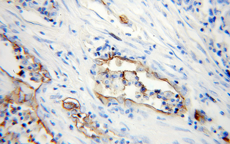 Immunohistochemical of paraffin-embedded human lung cancer using Catalog No:111587(ICAM-1 antibody) at dilution of 1:50 (under 25x lens)