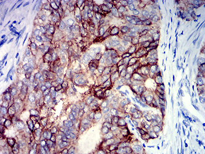 Fig3: Immunohistochemical analysis of paraffin-embedded human cervical cancer tissue using anti-TNFRSF18 antibody. The section was pre-treated using heat mediated antigen retrieval with Tris-EDTA buffer (pH 8.0) for 20 minutes. The tissues were blocked in 5% BSA for 30 minutes at room temperature, washed with ddH2O and PBS, and then probed with the primary antibody ( 1/100) for 30 minutes at room temperature. The detection was performed using an HRP conjugated compact polymer system. DAB was used as the chromogen. Tissues were counterstained with hematoxylin and mounted with DPX.