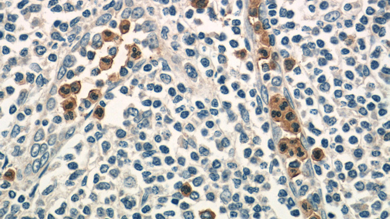 Immunohistochemistry of paraffin-embedded human tonsillitis tissue slide using Catalog No:108211(ASB14 Antibody) at dilution of 1:50 (under 40x lens)
