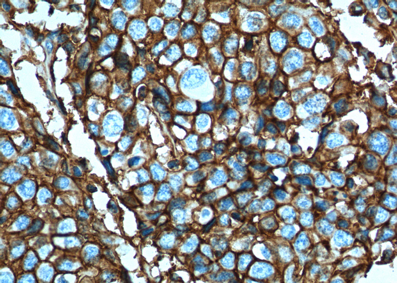 Immunohistochemistry of paraffin-embedded human lung cancer tissue slide using Catalog No:109124(CD44 Antibody) at dilution of 1:200 (under 40x lens). heat mediated antigen retrieved with Tris-EDTA buffer(pH9).