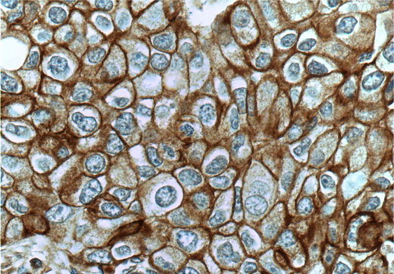 Immunohistochemistry of paraffin-embedded human breast cancer tissue slide using Catalog No:109414(MET Antibody) at dilution of 1:50 (under 40x lens)