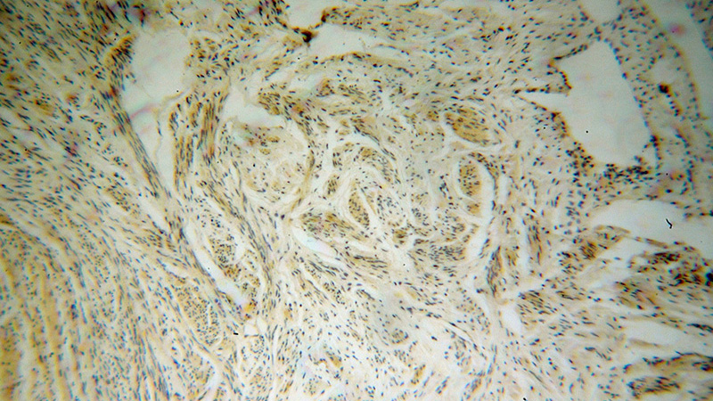 Immunohistochemical of paraffin-embedded human cervical cancer using Catalog No:116578(UROS antibody) at dilution of 1:50 (under 10x lens)