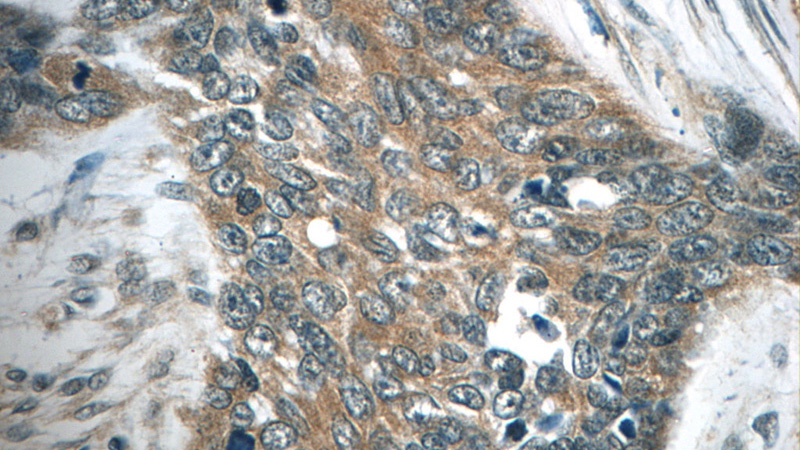 Immunohistochemistry of paraffin-embedded human skin cancer tissue slide using Catalog No:116275(TMPRSS3 Antibody) at dilution of 1:50 (under 40x lens)