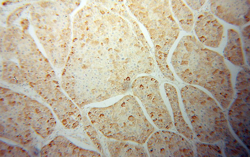 Immunohistochemical of paraffin-embedded human liver cancer using Catalog No:116906(ZBP1 antibody) at dilution of 1:50 (under 10x lens)