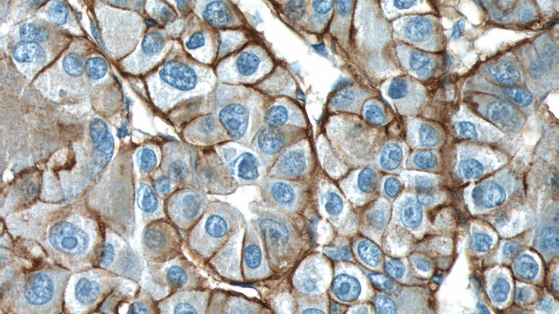 Immunohistochemistry of paraffin-embedded human liver cancer tissue slide using Catalog No:117301(ATP1A1 Antibody) at dilution of 1:200 (under 40x lens)