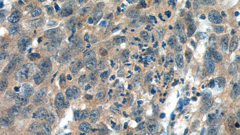 Immunohistochemistry of paraffin-embedded human cervical cancer tissue slide using Catalog No:111958(ITPKB Antibody) at dilution of 1:50 (under 40x lens)