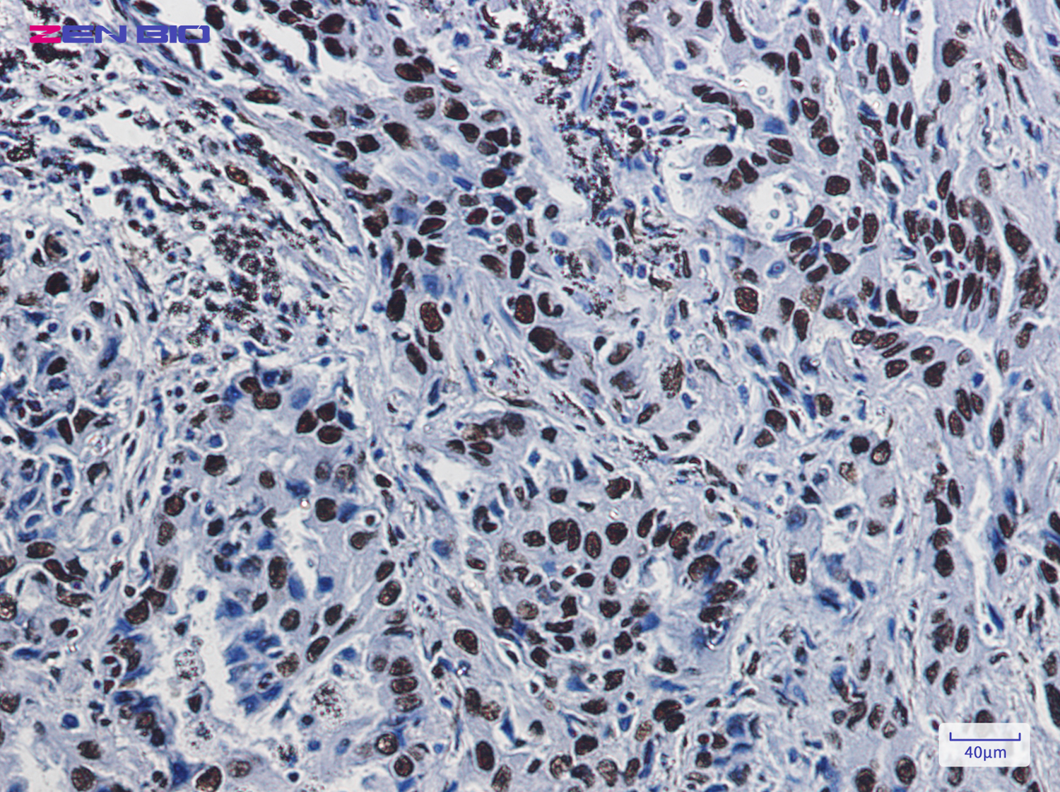 Immunohistochemistry of ILF3 in paraffin-embedded Human lung cancer tissue using ILF3 Rabbit pAb at dilution 1/50