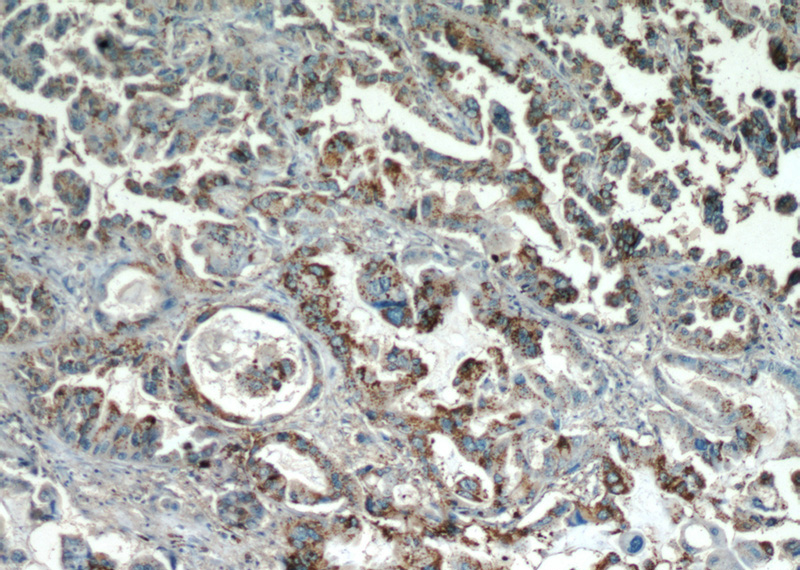Immunohistochemical of paraffin-embedded human lung cancer using Catalog No:111799(INHBA antibody) at dilution of 1:50 (under 10x lens)
