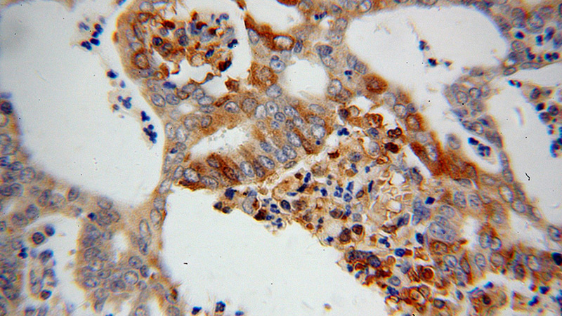 Immunohistochemical of paraffin-embedded human endometrial cancer using Catalog No:113586(PARN antibody) at dilution of 1:100 (under 40x lens)