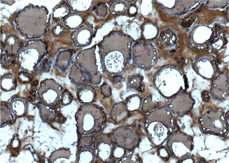 Immunohistochemistry of paraffin-embedded human thyroid tissue slide using Catalog No:107623(TG Antibody) at dilution of 1:200 (under 10x lens).
