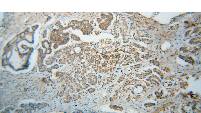Immunohistochemical of paraffin-embedded human ovary tumor using Catalog No:114382(PSMB2 antibody) at dilution of 1:50 (under 10x lens)