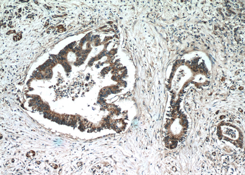 Immunohistochemistry of paraffin-embedded human pancreas cancer tissue slide using Catalog No:116085(TMED2 Antibody) at dilution of 1:50 (under 10x lens)