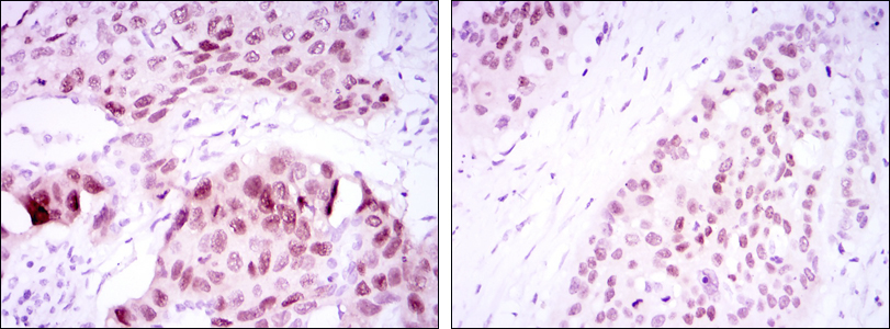 Immunohistochemical analysis of paraffin-embedded lung cancer tissues (left) and esophageal cancer tissues (right) using SOX2 mouse mAb with DAB staining.