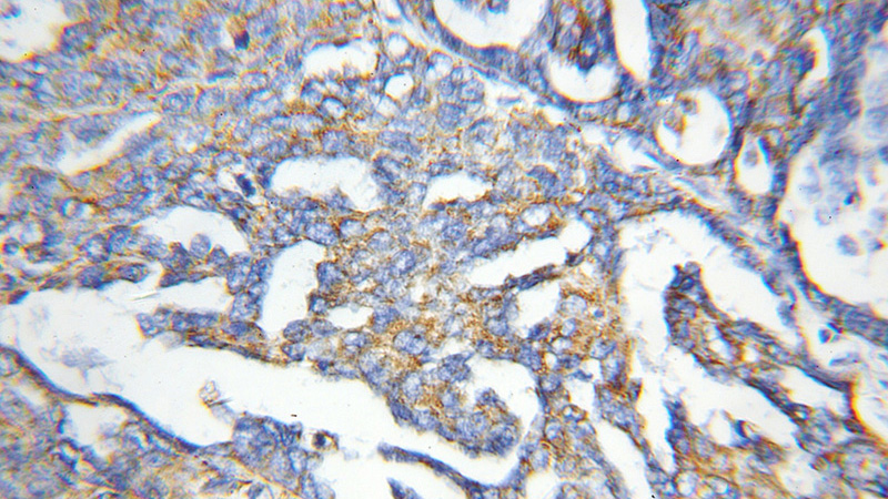 Immunohistochemical of paraffin-embedded human ovary tumor using Catalog No:110072(DPP9 antibody) at dilution of 1:50 (under 10x lens)