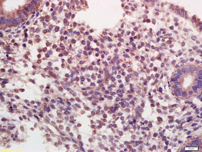 Fig2: Tissue/cell: Human endometrium tissue; 4% Paraformaldehyde-fixed and paraffin-embedded;; Antigen retrieval: citrate buffer ( 0.01M, pH 6.0 ), Boiling bathing for 15min; Block endogenous peroxidase by 3% Hydrogen peroxide for 30min; Blocking buffer (normal goat serum,C-0005) at 37℃ for 20 min;; Incubation: Anti-Oxytocin R Polyclonal Antibody, Unconjugated 1:200, overnight at 4℃, followed by conjugation to the secondary antibody(SP-0023) and DAB(C-0010) staining