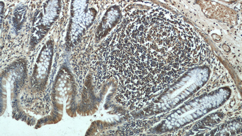 Immunohistochemical of paraffin-embedded human colon using Catalog No:111910(KANK2 antibody) at dilution of 1:100 (under 10x lens)